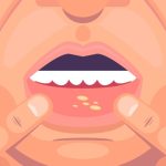 Top 10 Mouth Ulcer Gels in India Top 10 Mouth Ulcer Gels in India