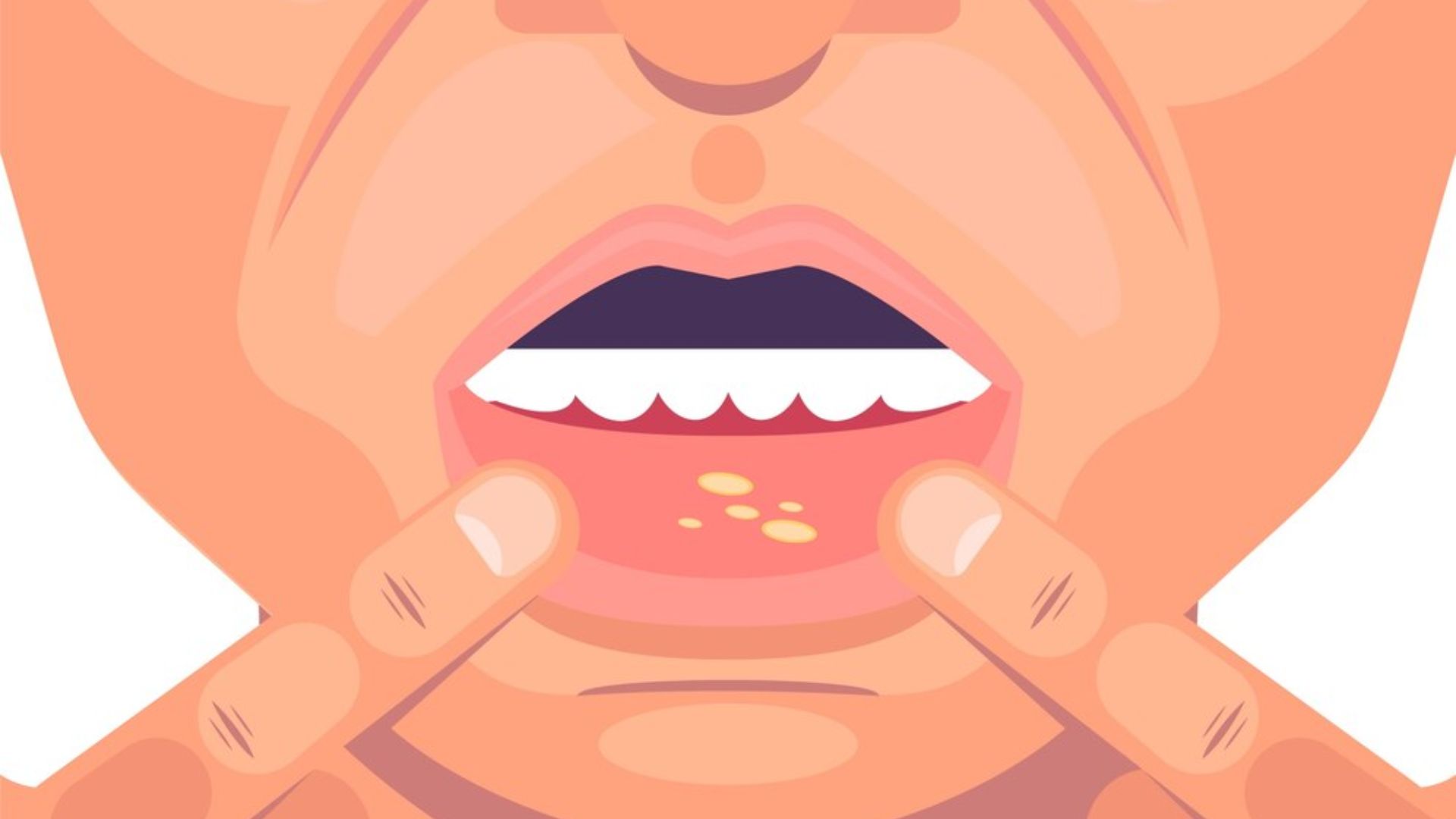Top 10 Mouth Ulcer Gels in India